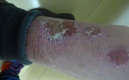 銀屑病護理,怎樣護理銀屑病,治療牛皮癬醫院,牛皮癬專科醫院