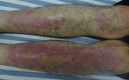 牛皮癬癥狀,牛皮癬癥狀圖片,治療牛皮癬醫院,牛皮癬專科醫院