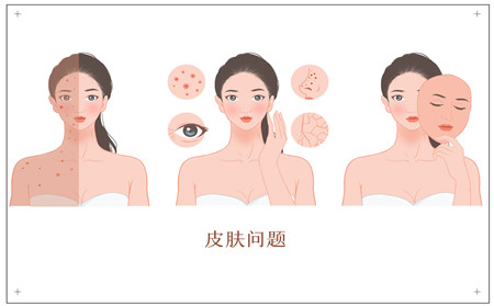 牛皮癬治療,冬季牛皮癬的治療,治療牛皮癬醫院,牛皮癬專科醫院