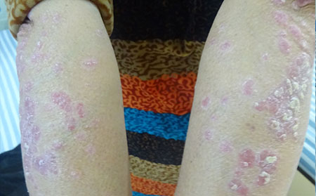 銀屑病飲食,得銀屑病不能吃什么